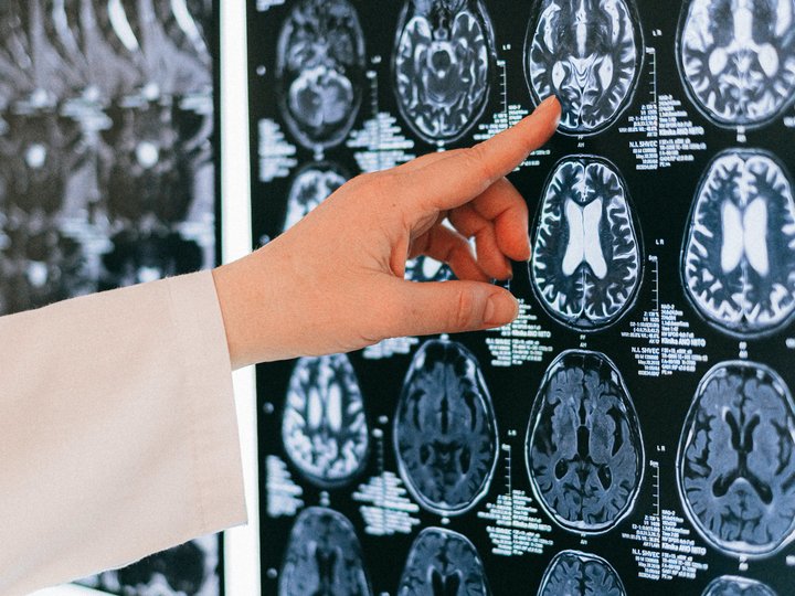 A healthcare worker points to a slide showing imaging of the brain.